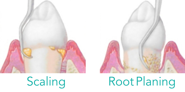tooth scaling and root planing