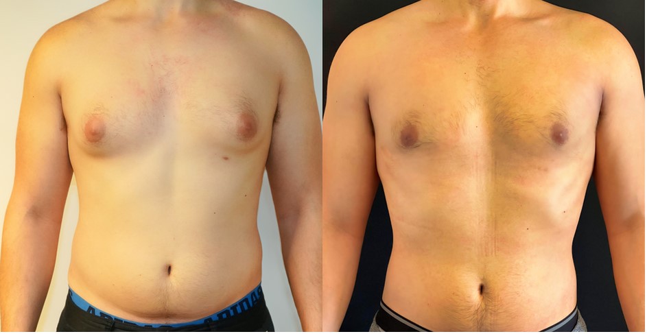 male breast reduction nyc